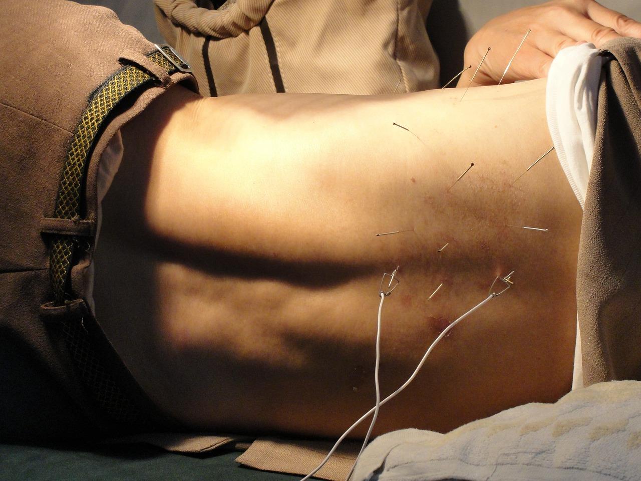 Een man wordt behandeld met acupunctuur in Delft